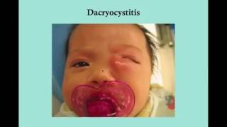 Dacryocystitis CRASH USMLE Step 2 and 3 [upl. by Snilloc608]