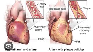 Angina Pectoris  Chest Pain  noorpharmacylectures8513 [upl. by Illom394]