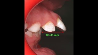 Amazing two phase treatment of Sever Class II Div 1  lama 10Y [upl. by Halverson]