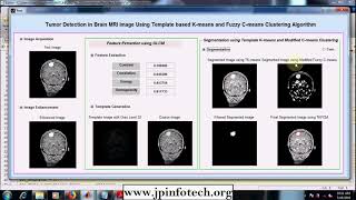 Tumor Detection in Brain MRI Image Using Template based Kmeans and Fuzzy Cmeans Clustering MATLAB [upl. by Lily]