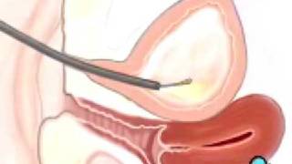 Malpractice Medical Cystoscopy Female Surgery 3 [upl. by Maris]