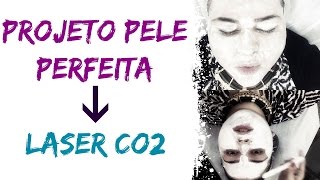 Projeto Pele Perfeita  Laser CO2 [upl. by Scotney]