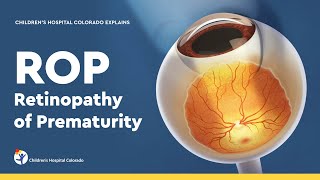 Retinopathy of Prematurity Diagnosis and Treatment [upl. by Asilet]