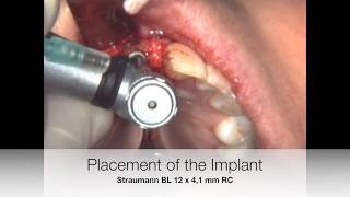 Implant placement in the incisive canal [upl. by Celestina]