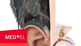 How Do Cochlear Implants Work  MEDEL [upl. by Mikkel429]