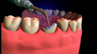 Reconstrucción de Diente [upl. by Saimon]