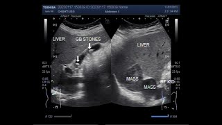 Multiple findings including gall stones single kidney and hepatic Mass [upl. by Weiman]