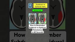 🔥 How to Remember Subdural vs Epidural Hematomas in 60 Seconds Nursing [upl. by Eisaj108]