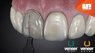 Uveneer® Procedure Animation  Direct Veneer Template System [upl. by Nnahoj]