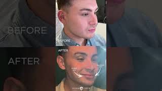 LIP PLUMP  MALE LIP AUGMENTATION [upl. by Flessel]