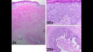 QuizAnatomic pathologyBreast pathology [upl. by Neneek]