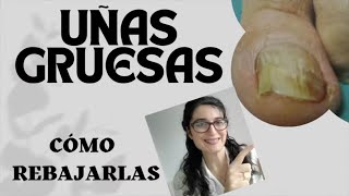 Cómo REBAJAR las UÑAS de los PIES 📶UÑAS GRUESAS por HONGOS PSORIASIS ANCIANOS [upl. by Llemaj622]