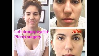 Scarless Congenital Droopy Upper Eyelid Ptosis Surgery in a young woman [upl. by Airehs]