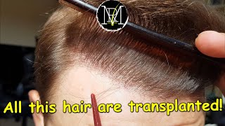 Im MAD 75 Months after FUE Hair Transplant  3500 grafts [upl. by Erle603]