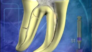 Procedimiento de tratamiento de conductos calcificados [upl. by Oiril]