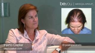 Resultados de Injerto Capilar en Mujeres Transplante de Pelo en mujer Beyou Medical Group HD [upl. by Alvis]