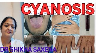 CYANOSIS Respiratory System Telegram httpstmedrshikhasaxenahumanphysio [upl. by Dielle]