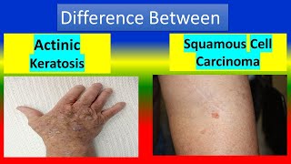 Difference between Actinic keratosis and Squamous cell carcinoma [upl. by Kawai]