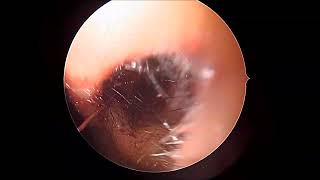 Unedited part 3 endoscopic septal correction spurectomy [upl. by Latrina]