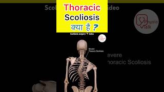 Everything You Need to Know About Thoracic scoliosis shorts scoliosisawareness trendingshorts [upl. by Loeb492]