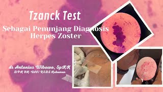 Tzanck Test  Pemeriksaan Penunjang untuk melihat Multinucleated Giant Cells pada Herpes Zoster [upl. by Ku]