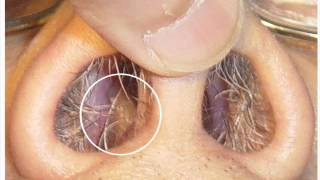 Nose Polyps [upl. by Brod621]