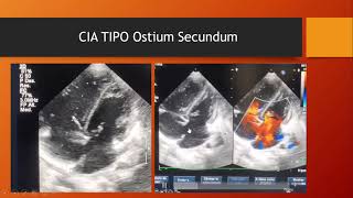 ECOCARDIOGRAMA EN CARDIOPATIAS CONGENITAS [upl. by Kakalina]