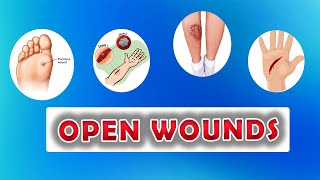 Types of Open Wounds Abrasion Laceration Skin Avulsion Puntured wounds [upl. by Erek]