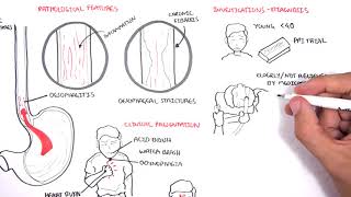 GORD GERD Gastro Oesophageal Reflux Disease  Overview pathophysiology treatment [upl. by Htrag]