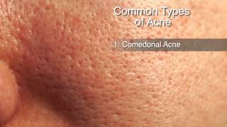 How to Treat Different Types of Acne [upl. by Nicholson764]