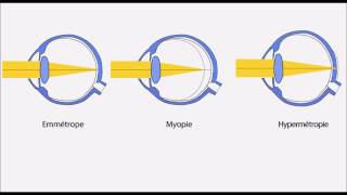 Amétropie hypermétropie myopie astigmatisme presbytie [upl. by Cirone]