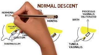 undescended testis crytorchidism [upl. by Trebo]