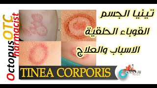 Tinea corporis Ringworm  تينيا الجسم  القوباء الحلقية  الأعراض والعلاج والوقاية [upl. by Enos]