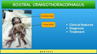 Conjoined Twins  Craniothoracophagus  Clinical features  Diagnosis  Treatment [upl. by Subocaj]