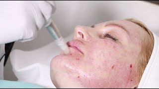 Hyaluronic acid mesotherapy and microneedling with vitamins [upl. by Enelrahc]