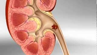 How Do Kidney Stones Form How Can We Prevent Them [upl. by Yrelle272]