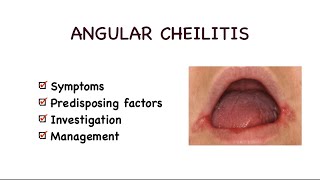 Angular cheilitis or Angular stomatitis [upl. by Ayotyal]