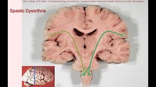 Spastic dysarthria  samples and tutorial [upl. by Arrekahs785]