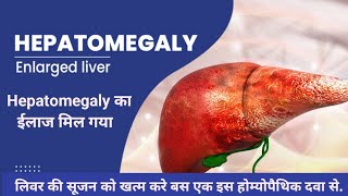 लिवर की सूजन का ईलाज Hepatomegaly Homeopthic Treatment liverdisease livermesujan maroofclinic [upl. by Sydelle568]