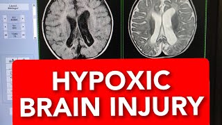 MRI of Hypoxic Ischaemic Brain Injury 10months Child shorts shortsvideo shortsvideos [upl. by Frederigo888]