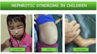 Nephrotic syndrome History mrcpch Clinical [upl. by Aicirtac]