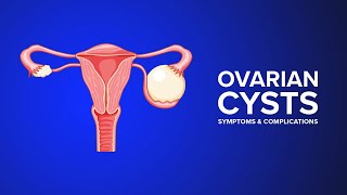 Ovarian Cysts  Symptoms and Complications Explained by an OBGYN [upl. by Bandur]