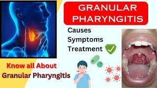 Granular Pharyngitis Causes Symptoms amp Treatment  sore throat treatment health [upl. by Aeikan]