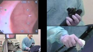 Colonoscopy  consecutive cases 120 [upl. by Adlitam]