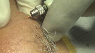 Permanent painless hair removal of chin electrolysis [upl. by Eniamraj]