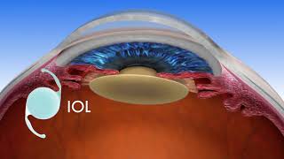 Trifocal Lens A Revolutionary Way to See After Cataract Surgery [upl. by Flan820]