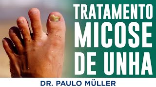 Tratamento de Micose de Unha  Dr Paulo Müller Dermatologista [upl. by Anilas]