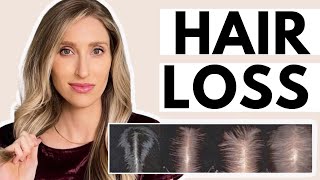 4 Reasons WHY Your Hair Loss amp Dandruff ISN’T Getting BETTER  5 TIPS [upl. by Edora]