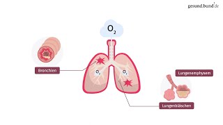 Was ist eine chronisch obstruktive Lungenerkrankung COPD [upl. by Thorner245]