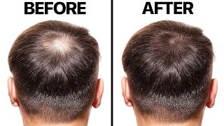 Minoxidil for Hair Loss [upl. by Labina]